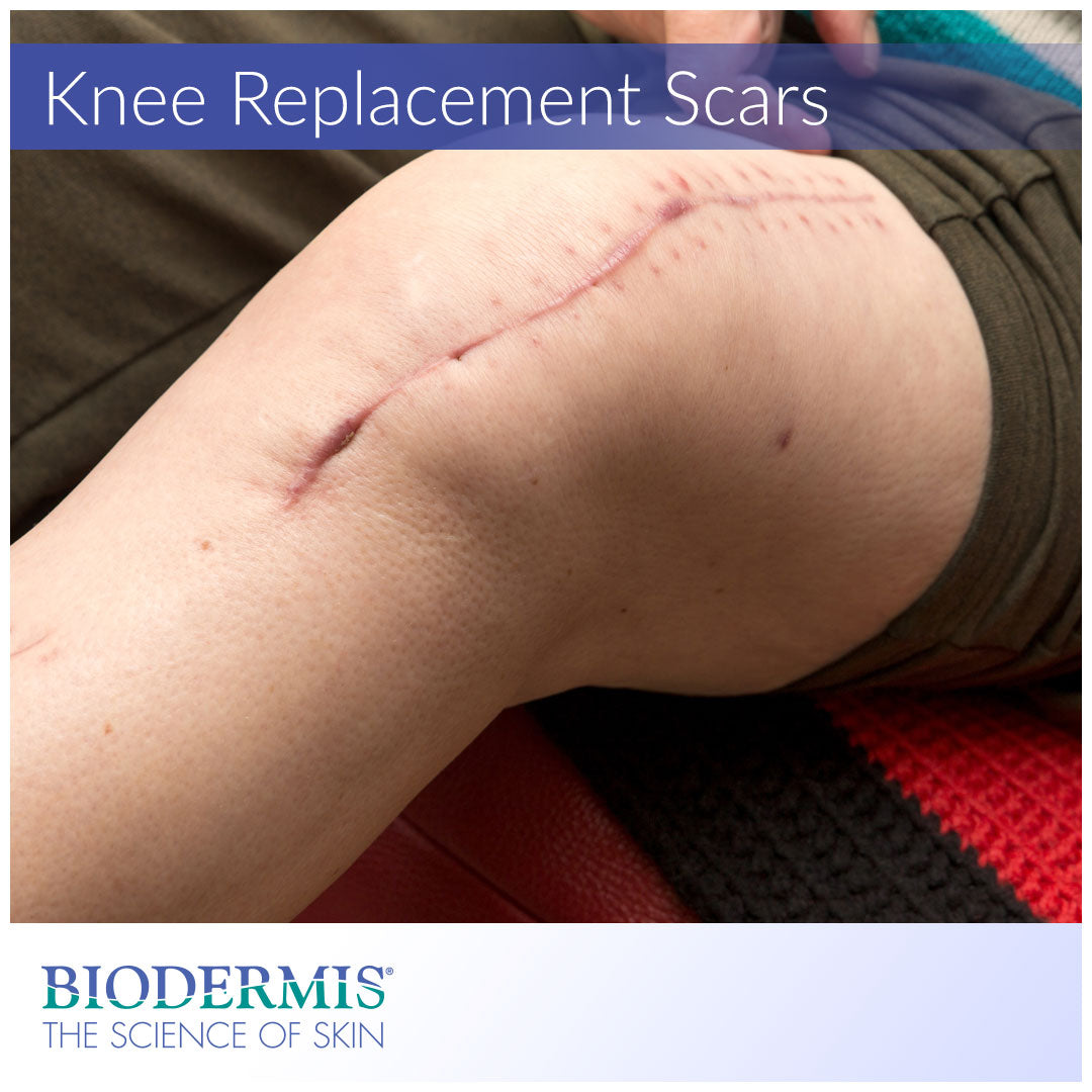 partial knee replacement scar