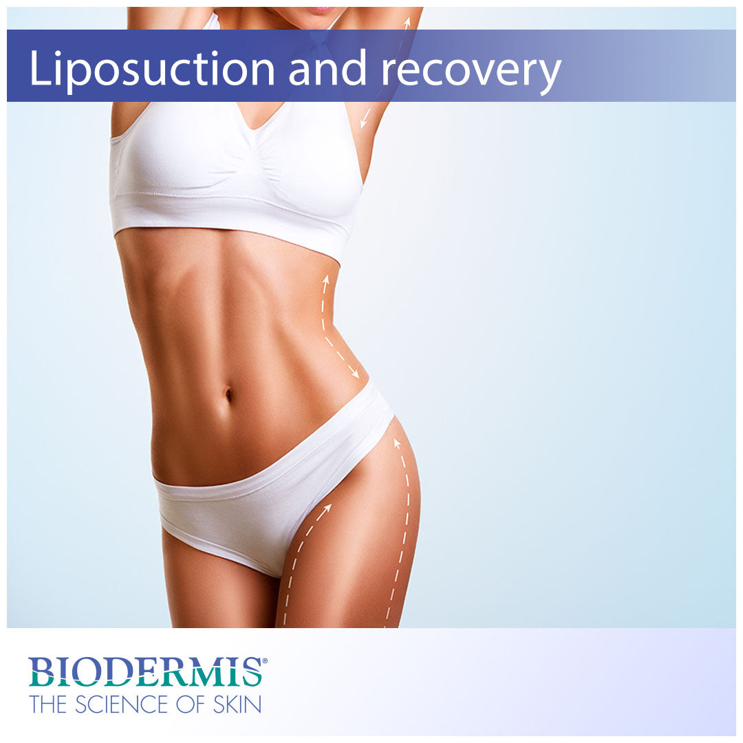 To-do List: How to Prepare for and Recover from Liposuction