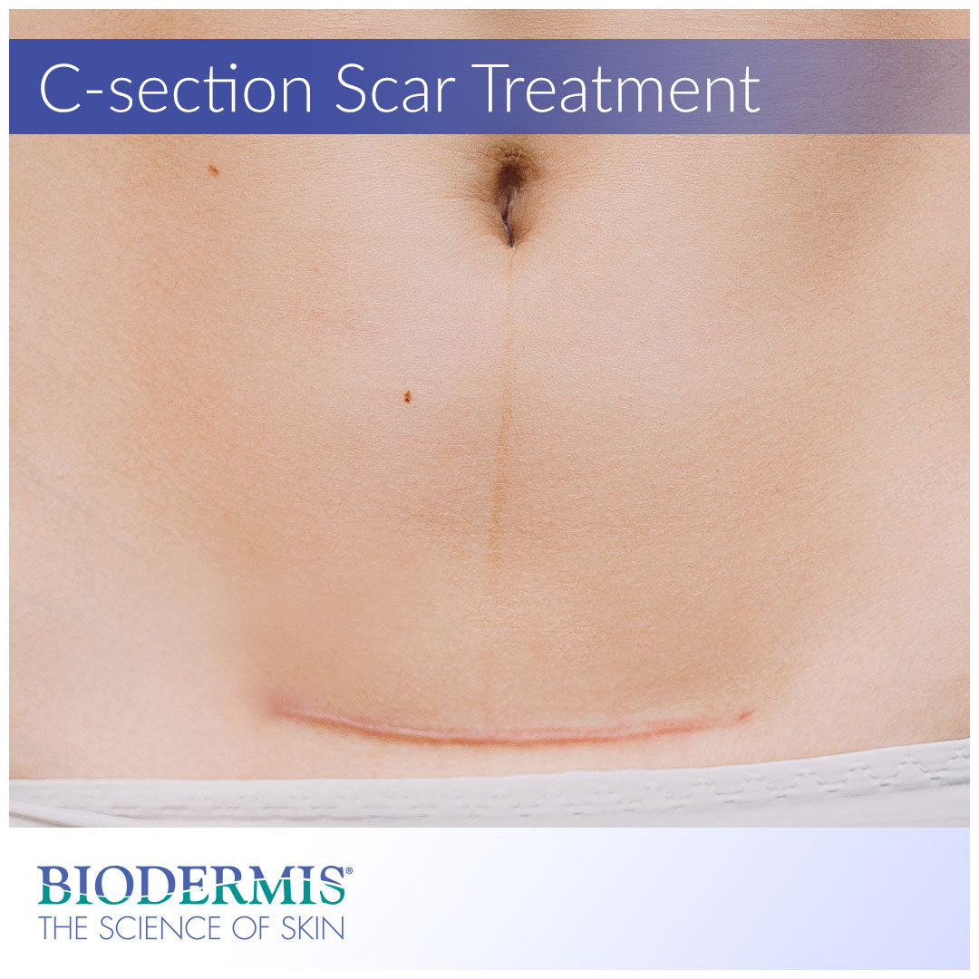 C-Section Scars: Types of Incisions, Healing, and Minimizing Scars