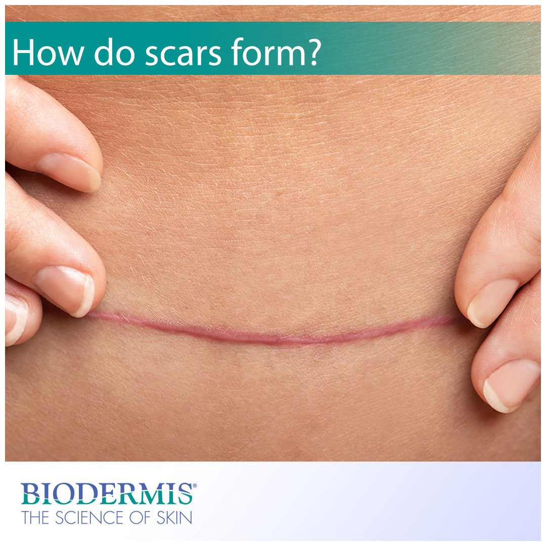 Where Does Scar Tissue Come From: Unraveling the Mystery of Scar Forma –  Motivo Scar Care