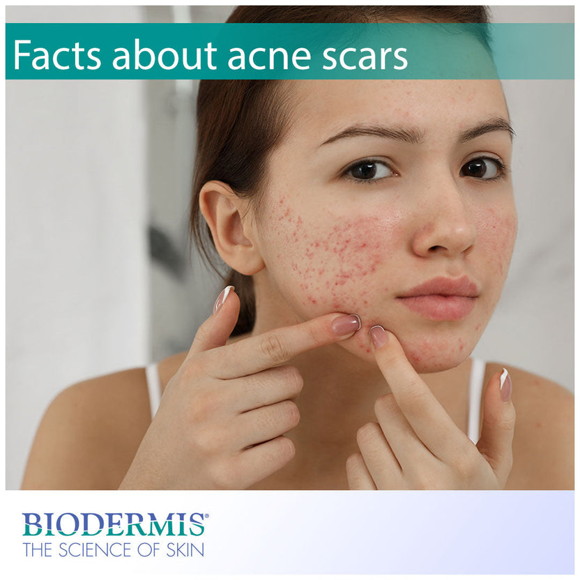 Interesting Facts about Acne Scars | Biodermis.com