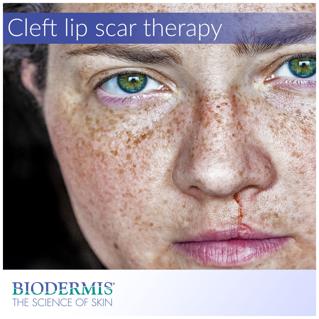 Scar Treatment for Cleft Lip Surgery | Biodermis.com