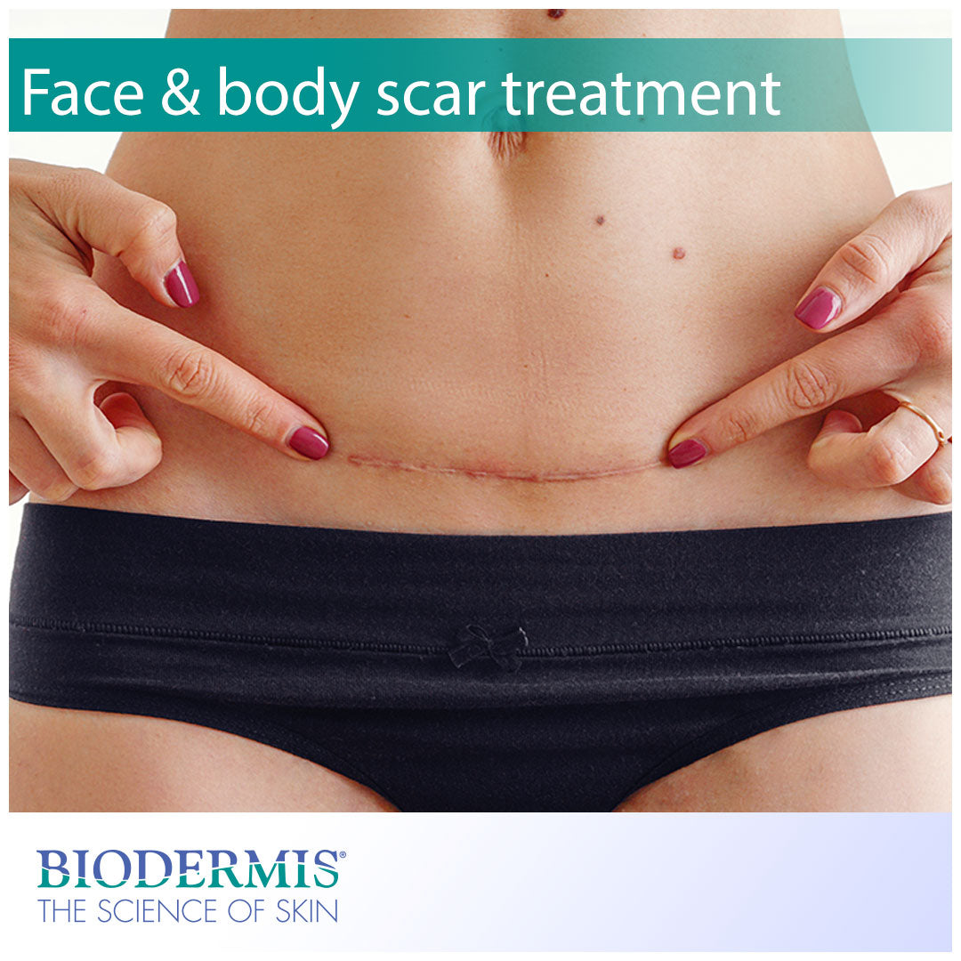 Treating Scars After a Tummy Tuck