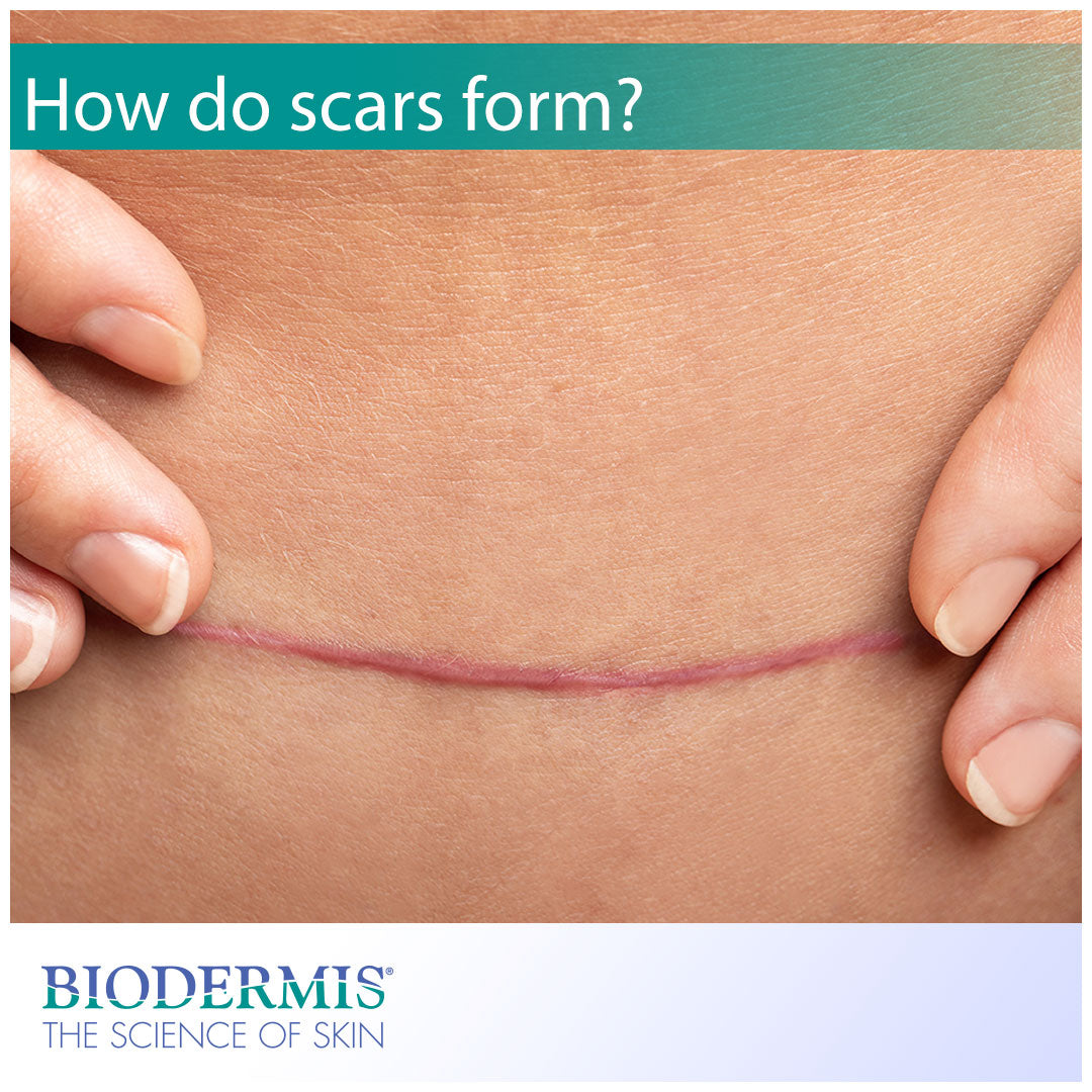 Why Do Scars Form? | Biodermis.com