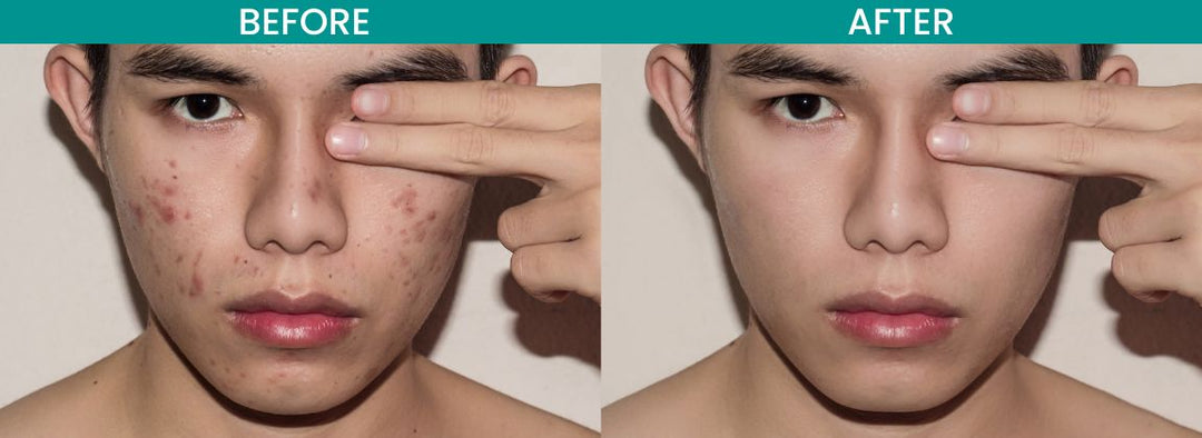 best acne scar treatment 